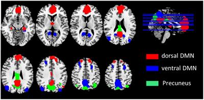 Frequency-Dependent Altered Functional Connections of Default Mode Network in Alzheimer’s Disease